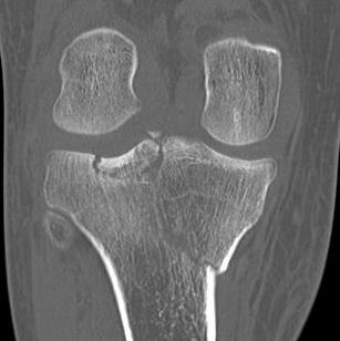 Schatzker 4 Tibial Plateau